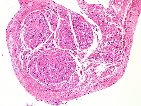 2D1 Malaria, heart (Case 2) papillary muscles H&E 3A