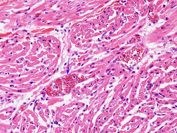 2D2 Malaria, heart (Case 2) papillary muscles H&E 