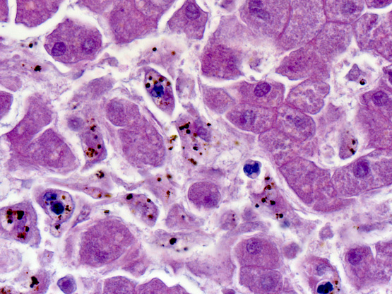 3 Malaria, liver 1 (Case 3)