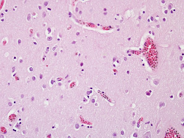 5 Malaria (Case 5) H&E 1