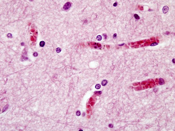 6A1 Malaria, cerebral (Case 6) H&E 5