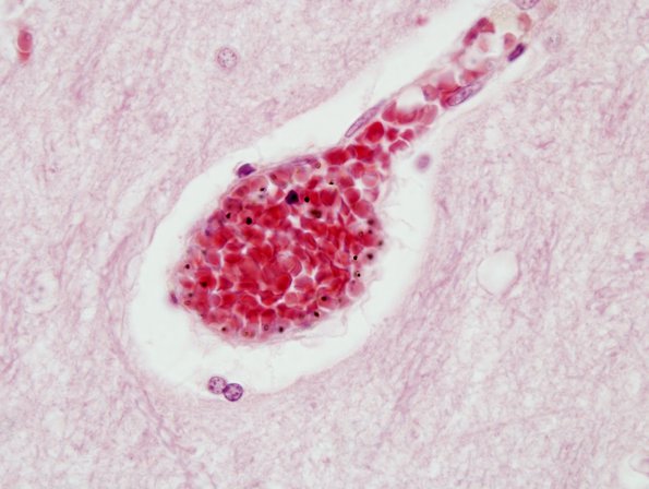 6A2 Malaria, cerebral (Case 6) H&E 4