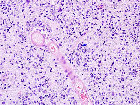 1A4 Sarcocystis (ZOO Raccoon (SW14-1700 B49-14-2) H&E 4