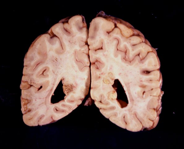 10A3 Toxoplasmosis (Case 10) 3