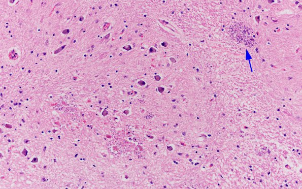 11A1 Toxoplasmosis (Case 11) 20X 1