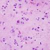 12A1 Toxoplasmosis (Case 12) H&E 40x