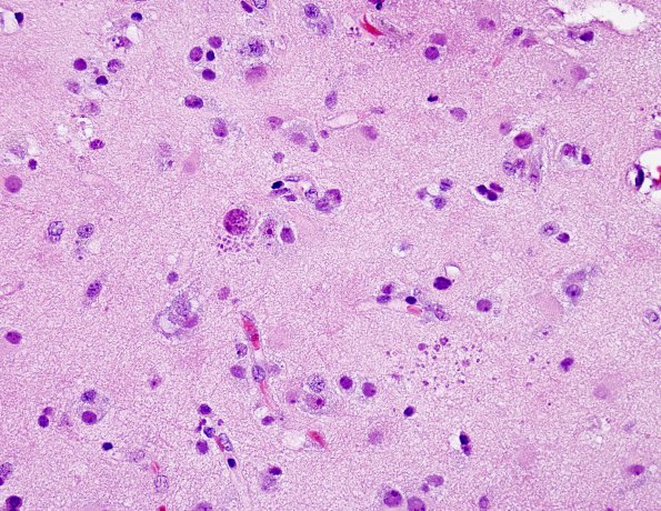 12A1 Toxoplasmosis (Case 12) H&E 40x