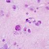 12A2 Toxoplasmosis (Case 12) H&E 100x