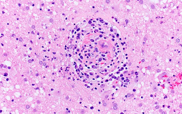 13 Toxoplasmosis (MGH Unknowns, my image) H&E 9