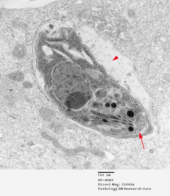 14A1 Toxoplasmosis Zijiang 2-11-08_002 - Copy AA