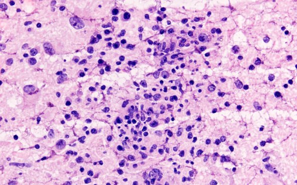 15A1 Toxoplasmosis vs nuclear crumbs (Case 15) FS series H&E 3