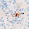 15B2 Toxoplasmosis (Case 15) Toxo 100X 3