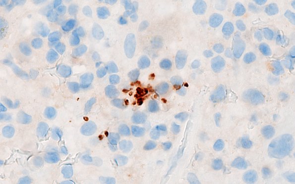 15B2 Toxoplasmosis (Case 15) Toxo 100X 3