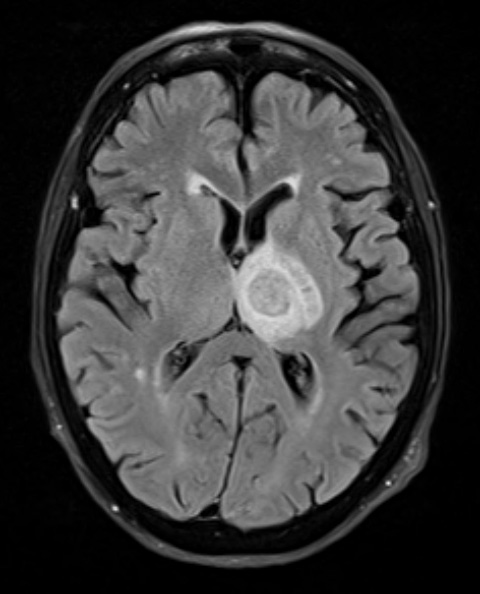 16A1 Toxoplasmosis (Case 16) TIRM - Copy