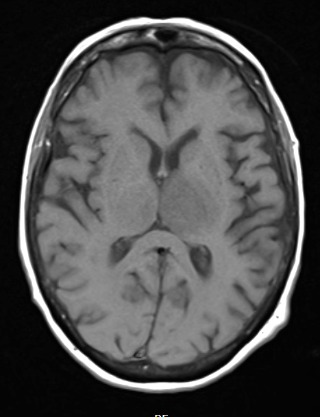 16A2 Toxoplasmosis (Case 16) T1 no C A - Copy