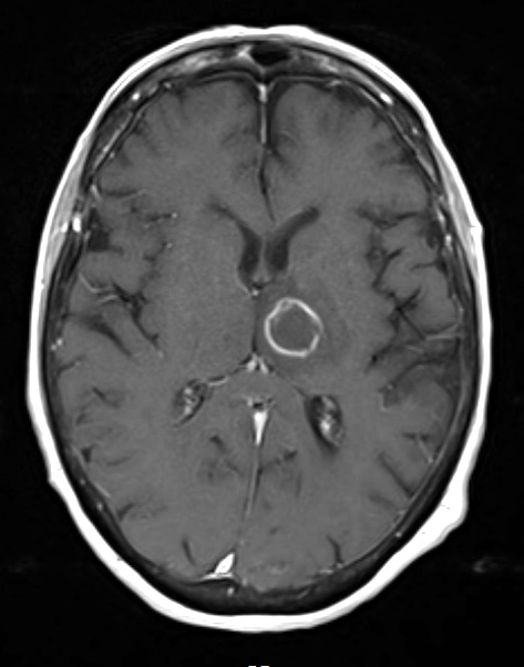 16A3 Toxoplasmosis (Case 16) T1 with C A - Copy