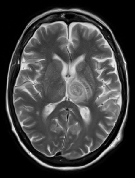 16A4 Toxoplasmosis (Case 16) T2 no C A - Copy