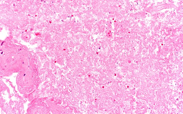 16B1 Toxoplasmosis (Case 16) H&E 40X