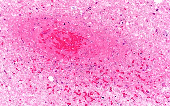 16B4 Toxoplasmosis (Case 16) H&E 100X 7