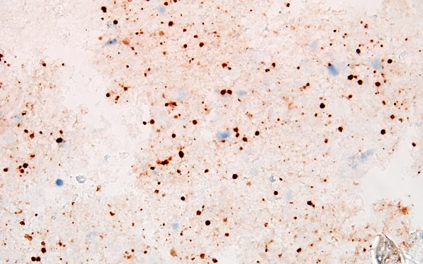 16C2 Toxoplasmosis (Case 16) Toxo 60X 4