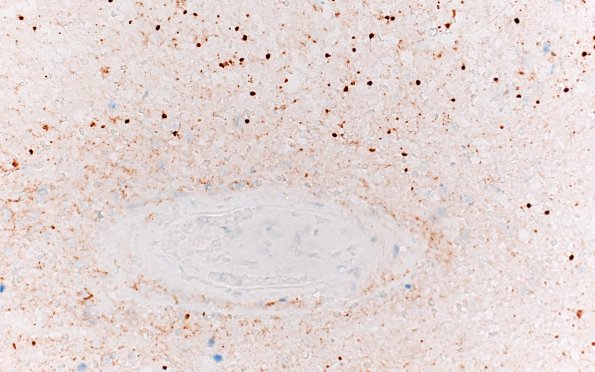 16C3 Toxoplasmosis (Case 16) Toxo 40X 2