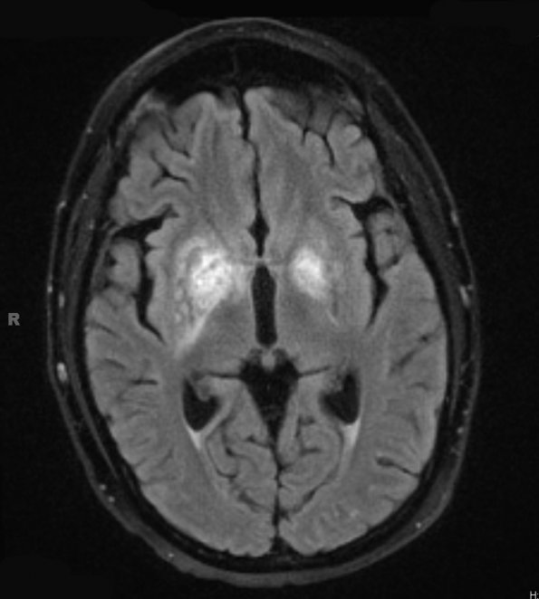 1A1 Toxoplasmosis Rx (Case 1) FLAIR BLADE 2 (2) - Copy