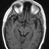 1A2 Toxoplasmosis Rx (Case 1) T1 W - Copy