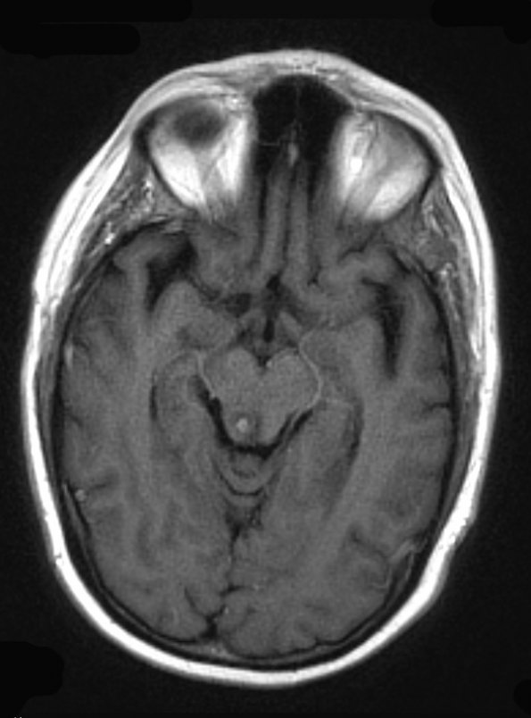 1A2 Toxoplasmosis Rx (Case 1) T1 W - Copy