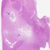 1C1 Toxoplasmosis Rx (Case 1) H&E whole mount 2