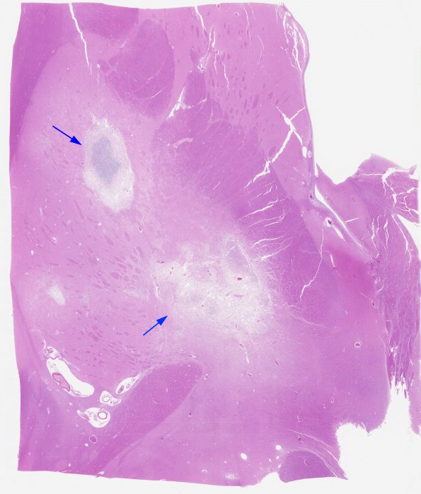 1C1 Toxoplasmosis Rx (Case 1) H&E whole mount 2