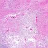 1C2 Toxoplasmosis Rx (Case 1) H&E 7