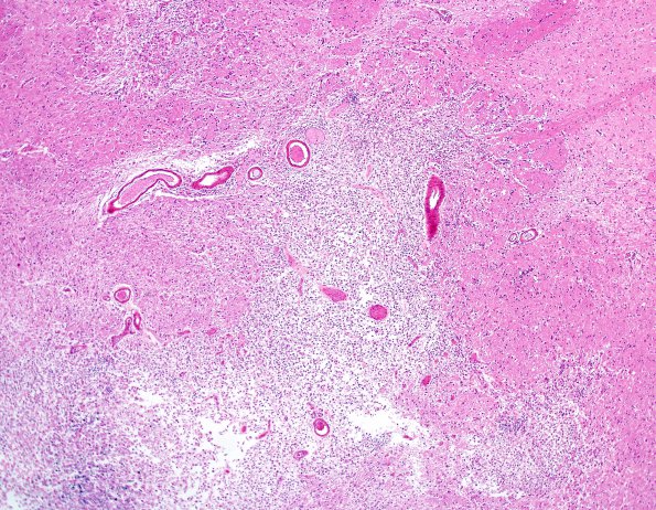 1C2 Toxoplasmosis Rx (Case 1) H&E 7