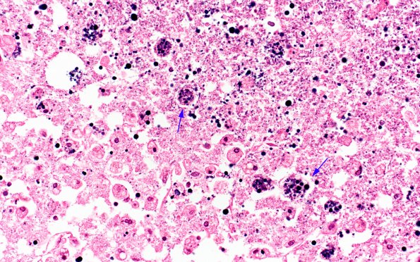 1C3 Toxoplasmosis (Case 1) H&E 1 dystrophic calculations 40X C