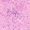 1C4 Toxoplasmosis Rx (Case 1) H&E 24A