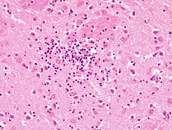 1C4 Toxoplasmosis Rx (Case 1) H&E 24A