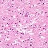 1C5 Toxoplasmosis Rx (Case 1) H&E 8