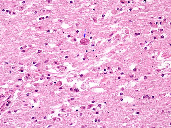 1C5 Toxoplasmosis Rx (Case 1) H&E 8