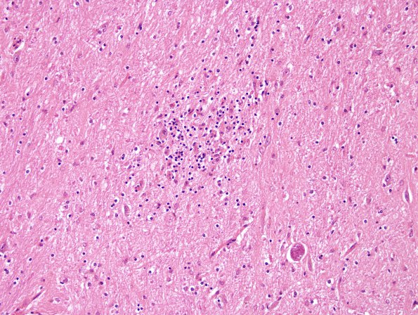 1C6 Toxoplasmosis Rx (Case 1) H&E 16