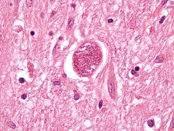 1C7 Toxoplasmosis Rx (Case 1) H&E 100X 4