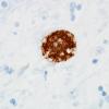 1D Toxoplasmosis Rx (Case 1) Anti-Toxo 1