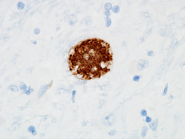 1D Toxoplasmosis Rx (Case 1) Anti-Toxo 1