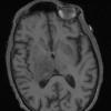 2A1 Toxoplasmosis (Case 2) T1 - Copy