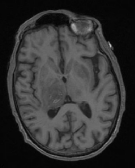 2A1 Toxoplasmosis (Case 2) T1 - Copy