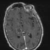 2A2 Toxoplasmosis (Case 2) T1 W - Copy