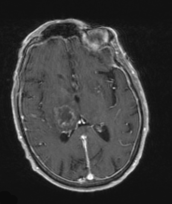 2A2 Toxoplasmosis (Case 2) T1 W - Copy