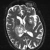 2A3 Toxoplasmosis (Case 2) T2 W (2) - Copy