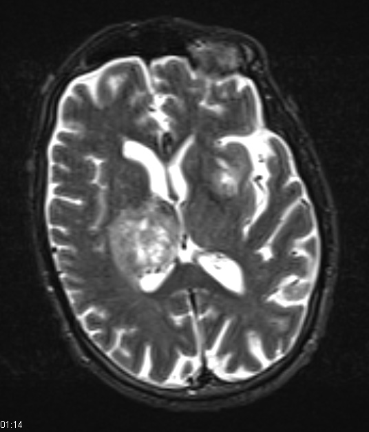 2A3 Toxoplasmosis (Case 2) T2 W (2) - Copy