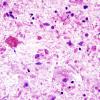 2B1 Toxoplasmosis (Case 2) H&E smear 2