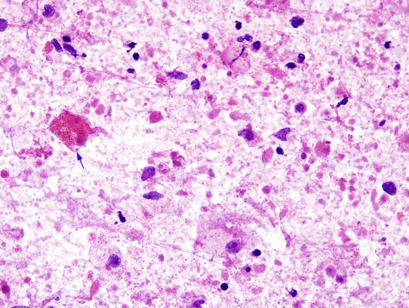 2B1 Toxoplasmosis (Case 2) H&E smear 2