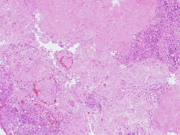 2B2 Toxoplasmosis (Case 2) H&E 2.